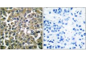 Immunohistochemistry analysis of paraffin-embedded human breast carcinoma tissue, using Keratin 16 Antibody. (KRT16 Antikörper  (AA 421-470))
