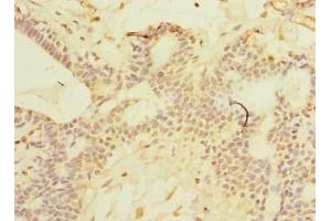 Immunohistochemistry of paraffin-embedded human breast cancer using ABIN7169911 at dilution of 1:100 (SCNM1 Antikörper  (AA 1-230))