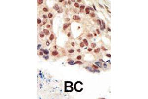 Formalin-fixed and paraffin-embedded human cancer tissue reacted with PRKG2 polyclonal antibody  , which was peroxidase-conjugated to the secondary antibody, followed by AEC staining. (PRKG2 Antikörper  (C-Term))
