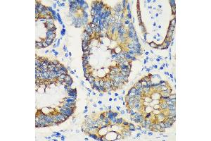 Immunohistochemistry of paraffin-embedded Human colon carcinoma using USP47 Rabbit pAb (ABIN7271166) at dilution of 1:100 (40x lens). (USP47 Antikörper  (AA 1128-1287))
