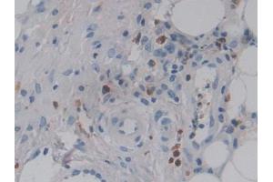DAB staining on IHC-P; Samples: Human Skin cancer Tissue