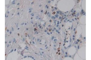 DAB staining on IHC-P; Samples: Human Skin cancer Tissue (CSF2RA Antikörper  (AA 28-112))