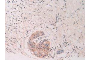 IHC-P analysis of Human Pancreas Cancer Tissue, with DAB staining. (Chordin Antikörper  (AA 700-918))