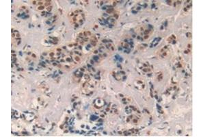 Detection of CXCL7 in Human Breast cancer Tissue using Polyclonal Antibody to Chemokine (C-X-C motif) ligand 7 ( CXCL7) (CXCL7 Antikörper  (AA 59-128))