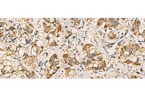 Immunohistochemistry of paraffin-embedded Human liver cancer tissue using VTA1 Polyclonal Antibody at dilution of 1:60(x200)