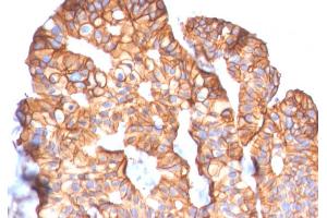 Formalin-fixed, paraffin-embedded human Breast Carcinoma stained with HER-2 Mouse Monoclonal Antibody (ERBB2/2452). (ErbB2/Her2 Antikörper  (AA 311-462))
