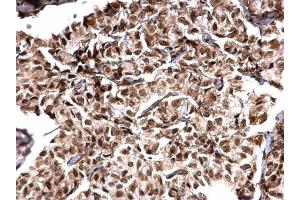IHC-P Image MTA1 antibody [C1C3] detects MTA1 protein at nucleus on human breast carcinoma by immunohistochemical analysis. (MTA1 Antikörper)