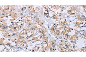 Immunohistochemistry of paraffin-embedded Human thyroid cancer tissue using CCR9 Polyclonal Antibody at dilution 1:60 (CCR9 Antikörper)