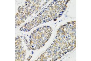 Immunohistochemistry of paraffin-embedded human esophageal cancer using IKBKG antibody (ABIN5970336) at dilution of 1/100 (40x lens). (IKBKG Antikörper)