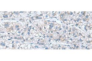 Immunohistochemistry of paraffin-embedded Human liver cancer tissue using GDF9 Polyclonal Antibody at dilution of 1:55(x200) (GDF9 Antikörper)