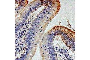 Immunohistochemical analysis of CD212 staining in human colon cancer formalin fixed paraffin embedded tissue section.