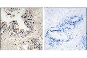 Immunohistochemistry analysis of paraffin-embedded human prostate carcinoma tissue, using MRPS36 Antibody. (MRPS36 Antikörper  (AA 4-53))