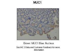 Sample Type :  Human stomach  Primary Antibody Dilution :  1:500  Secondary Antibody :  Anti-rabbit-HRP  Secondary Antibody Dilution :  1:1000  Color/Signal Descriptions :  Brown: MUC1 Blue: Nucleus  Gene Name :  MUC1  Submitted by :  Dr. (MUC1 Antikörper  (C-Term))