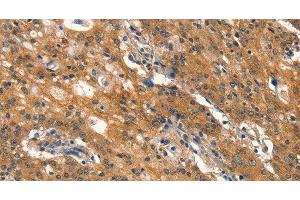 Immunohistochemistry of paraffin-embedded Human gastic cancer using DNM2 Polyclonal Antibody at dilution of 1:40 (DNM2 Antikörper)