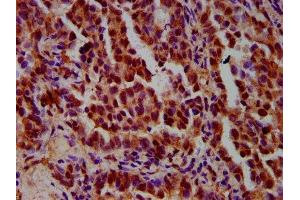 IHC image of ABIN7156289 diluted at 1:600 and staining in paraffin-embedded human lung cancer performed on a Leica BondTM system. (IMPDH1 Antikörper  (AA 191-281))