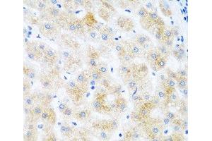 Immunohistochemistry of paraffin-embedded Human liver cancer using DHODH Polyclonal Antibody at dilution of 1:100 (40x lens). (DHODH Antikörper)