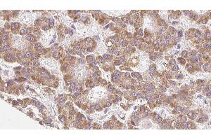 ABIN6279168 at 1/100 staining Human liver cancer tissue by IHC-P. (ABCC8 Antikörper)