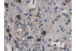 DAB staining on IHC-P; Samples: Human Lung cancer Tissue (RNASE3 Antikörper  (AA 30-154))