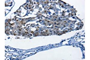 The image on the left is immunohistochemistry of paraffin-embedded Human breast cancer tissue using ABIN7190003(BPIFB1 Antibody) at dilution 1/25, on the right is treated with synthetic peptide. (BPIFB1 Antikörper)