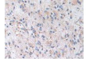 IHC-P analysis of Human Glioma Tissue, with DAB staining. (AKAP11 Antikörper  (AA 1650-1901))