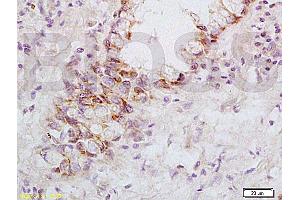 Formalin-fixed and paraffin embedded: human rectal carcinoma labeled with Anti-FasL Polyclonal Antibody, Unconjugated (ABIN726410) at 1:200, followed by conjugation to the secondary antibody and DAB staining (FASL Antikörper  (AA 196-281))