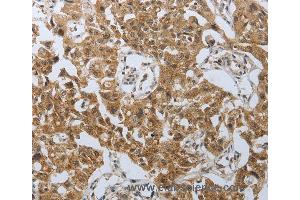 Immunohistochemistry of Human lung cancer using PSMD6 Polyclonal Antibody at dilution of 1:40 (PSMD6 Antikörper)