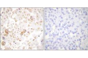 Immunohistochemistry analysis of paraffin-embedded human breast carcinoma tissue, using Cyclin F Antibody. (Cyclin F Antikörper  (AA 737-786))
