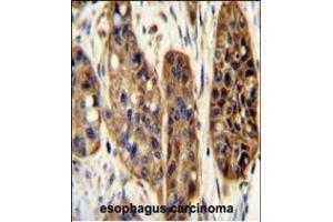 KIL Antibody (N-term) (ABIN654924 and ABIN2844567) immunohistochemistry analysis in formalin fixed and paraffin embedded human esophagus carcinoma followed by peroxidase conjugation of the secondary antibody and DAB staining. (KIAA1324-Like Antikörper  (N-Term))