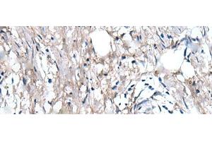 Immunohistochemistry of paraffin-embedded Human gastric cancer tissue using WRN Polyclonal Antibody at dilution of 1:55(x200) (RECQL2 Antikörper)