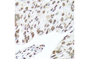 Immunohistochemistry of paraffin-embedded human prostate cancer using HNRNPR antibody at dilution of 1:100 (40x lens).