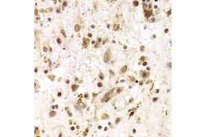 Immunohistochemistry of paraffin-embedded human liver cancer using PRPF3 Antibody (ABIN1876670) at dilution of 1:100 (40x lens). (PRPF3 Antikörper)