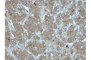 IHC analysis of formalin-fixed paraffin-embedded liver cancer tissue with cytoplasmic staining, using FUCA2 antibody (1/100 dilution).