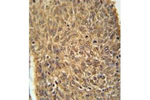Immunohistochemistry analysis in formalin fixed and paraffin embedded human lung carcinoma reacted with KIAA0652 Antibody (N-term) followed which was peroxidase conjugated to the secondary antibody and followed byDAB staining. (ATG13 Antikörper  (N-Term))