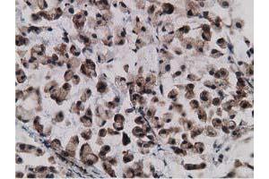 Immunohistochemical staining of paraffin-embedded Adenocarcinoma of Human colon tissue using anti-GPHN mouse monoclonal antibody. (Gephyrin Antikörper)