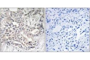 Immunohistochemistry analysis of paraffin-embedded human liver carcinoma tissue, using APOL5 Antibody. (Apolipoprotein L 5 Antikörper  (AA 384-433))