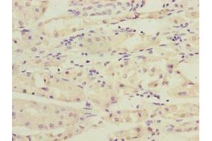 Immunohistochemistry of paraffin-embedded human gastric cancer using ABIN7167348 at dilution of 1:100