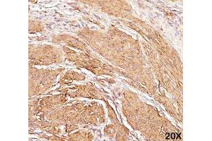 IHC staining of human leiomyosarcoma (20X) with Muscle actin antibody (HHF35). (Actin Antikörper)