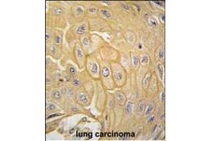 Formalin-fixed and paraffin-embedded human lung carcinoma tissue reacted with MCK10 antibody (ABIN392016 and ABIN2841793) , which was peroxidase-conjugated to the secondary antibody, followed by DAB staining. (DDR1 Antikörper)