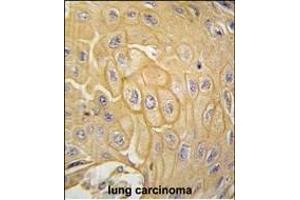 Formalin-fixed and paraffin-embedded human lung carcinoma tissue reacted with MCK10 antibody (ABIN392016 and ABIN2841793) , which was peroxidase-conjugated to the secondary antibody, followed by DAB staining.
