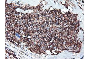 Immunohistochemical staining of paraffin-embedded Adenocarcinoma of Human breast tissue using anti-CYP2B6 mouse monoclonal antibody. (CYP2B6 Antikörper)