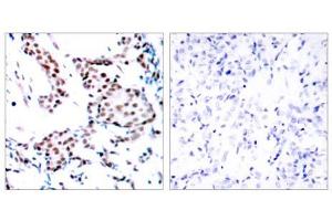 Immunohistochemical analysis of paraffin-embedded human breast carcinoma tissue using c-Jun (Ab-170) antibody (E021023). (C-JUN Antikörper)