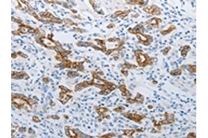 The image on the left is immunohistochemistry of paraffin-embedded Human gastric cancer tissue using ABIN7192809(TMEM8B Antibody) at dilution 1/15, on the right is treated with synthetic peptide. (TMEM8B Antikörper)
