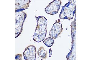Immunohistochemistry of paraffin-embedded human colon carcinoma using cGAS Rabbit pAb (ABIN6134073, ABIN6143590, ABIN6143591 and ABIN6224360) at dilution of 1:50 (40x lens). (C6orf150 Antikörper  (AA 350-522))