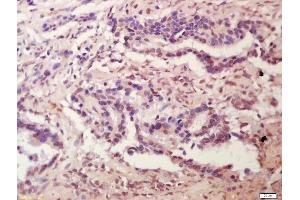 Formalin-fixed and paraffin embedded human colon carcinoma labeled with Anti-Plakophilin 2 Polyclonal Antibody, Unconjugated (ABIN1386389) at 1:200 followed by conjugation to the secondary antibody and DAB staining