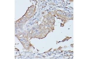 Immunohistochemistry of paraffin-embedded human oophoroma using CE Rabbit pAb (ABIN3015546, ABIN3015547, ABIN3015548 and ABIN6218802) at dilution of 1:100 (40x lens). (CEACAM1 Antikörper  (AA 300-430))