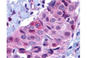 Immunohistochemistry of BBC3 in human breast carcinoma with BBC3 polyclonal antibody  at 10 ug/mL . (PUMA Antikörper  (N-Term))