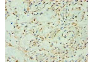 Immunohistochemistry of paraffin-embedded human breast cancer using ABIN7170604 at dilution of 1:100 (Spindlin 2B Antikörper  (AA 1-258))