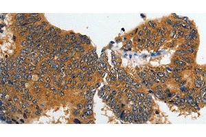 Immunohistochemistry of paraffin-embedded Human colon cancer tissue using GluR2 Polyclonal Antibody at dilution 1:70 (GRIA2 Antikörper)