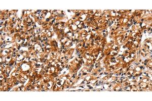 Immunohistochemistry of paraffin-embedded Human prostate cancer tissue using TRIM69 Polyclonal Antibody at dilution 1:40 (TRIM69 Antikörper)