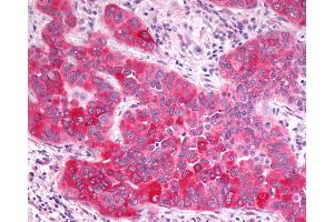 Anti-GPR17 antibody IHC of human Lung, Non-Small Cell Carcinoma.